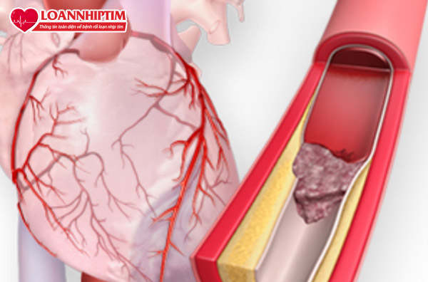 Nhồi máu cơ tim là do bị tắc nghẽn động mạch vành